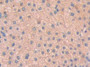 DAB staining on IHC-P; Samples: Human Liver cancer Tissue; Primary Ab: 20µg/ml Rabbit Anti-Human PAH Antibody Second Ab: 2µg/mL HRP-Linked Caprine Anti-Rabbit IgG Polyclonal Antibody