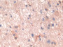 DAB staining on IHC-P; Samples: Human Glioma Tissue; Primary Ab: 30µg/ml Rabbit Anti-Human PTHR1 Antibody Second Ab: 2µg/mL HRP-Linked Caprine Anti-Rabbit IgG Polyclonal Antibody