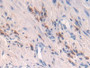 DAB staining on IHC-P; Samples: Human Prostate cancer Tissue;  Primary Ab: 30µg/ml Rabbit Anti-Human