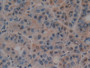 DAB staining on IHC-P; Samples: Human Liver cancer Tissue; Primary Ab: 20µg/ml Rabbit Anti-Human PTF1a Antibody Second Ab: 2µg/mL HRP-Linked Caprine Anti-Rabbit IgG Polyclonal Antibody