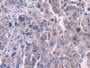 DAB staining on fromalin fixed paraffin- embedded stomach cancer tissue)