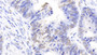 DAB staining on IHC-P; Samples: Human Colorectal cancer Tissue; Primary Ab: 20μg/ml Rabbit Anti-Human NPM Antibody Second Ab: 2µg/mL HRP-Linked Caprine Anti-Rabbit IgG Polyclonal Antibody