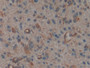 DAB staining on IHC-P; Samples: Human Glioma Tissue;  Primary Ab: 10µg/ml Rabbit Anti-Human MSN Anti