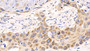 DAB staining on IHC-P; Samples: Human Lung cancer Tissue; Primary Ab: 20ug/ml Rabbit Anti-Mouse MCL1 Antibody Second Ab: 2µg/mL HRP-Linked Caprine Anti-Rabbit IgG Polyclonal Antibody