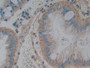 DAB staining on IHC-P; Samples: Human Colorectal cancer Tissue; Primary Ab: 10µg/ml Rabbit Anti-Human VEGI Antibody Second Ab: 2µg/mL HRP-Linked Caprine Anti-Rabbit IgG Polyclonal Antibody