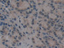 DAB staining on IHC-P; Samples: Human Prostate cancer Tissue; Primary Ab: 10µg/ml Rabbit Anti-Human VIL1 Antibody Second Ab: 2µg/mL HRP-Linked Caprine Anti-Rabbit IgG Polyclonal Antibody