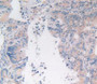 DAB staining on IHC-P; Samples：Human Rectum Cancer Tissue.
