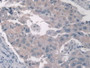 DAB staining on IHC-P; Samples: Human Breast Cancer Tissue.