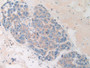 DAB staining on IHC-P; Samples: Human Breast cancer Tissue; Primary Ab: 10µg/ml Rabbit Anti-Human HAND1 Antibody Second Ab: 2µg/mL HRP-Linked Caprine Anti-Rabbit IgG Polyclonal Antibody