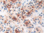 DAB staining on IHC-P; Samples: Human Prostate cancer Tissue; Primary Ab: 10µg/ml Rabbit Anti-Human GCPII Antibody Second Ab: 2µg/mL HRP-Linked Caprine Anti-Rabbit IgG Polyclonal Antibody