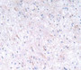 DAB staining on IHC-P; Samples：Human Glioma Tissue.