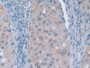 DAB staining on IHC-P; Samples: Human Breast cancer Tissue; Primary Ab: 10µg/ml Rabbit Anti-Human GFM1 Antibody Second Ab: 2µg/mL HRP-Linked Caprine Anti-Rabbit IgG Polyclonal Antibody