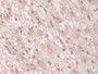 DAB staining on IHC-P; Samples: Human Glioma Tissue; Primary Ab: 10µg/ml Rabbit Anti-Human GCA Antibody Second Ab: 2µg/mL HRP-Linked Caprine Anti-Rabbit IgG Polyclonal Antibody