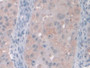 DAB staining on IHC-P; Samples: Human Breast cancer Tissue; Primary Ab: 10µg/ml Rabbit Anti-Human GAMT Antibody Second Ab: 2µg/mL HRP-Linked Caprine Anti-Rabbit IgG Polyclonal Antibody