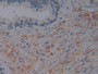 DAB staining on IHC-P; Samples: Human Prostate Tissue; Primary Ab: 10µg/ml Rabbit Anti-Human FAPa Antibody Second Ab: 2µg/mL HRP-Linked Caprine Anti-Rabbit IgG Polyclonal Antibody