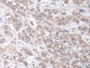 DAB staining on IHC-P; Samples: Human Breast cancer Tissue;  Primary Ab: 20µg/ml Rabbit Anti-Human E