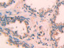 DAB staining on fromalin fixed paraffin- embedded rectum cancer tissue)