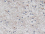 DAB staining on IHC-P; Samples: Human Glioma Tissue; Primary Ab: 30µg/ml Rabbit Anti-Human DBN1 Antibody Second Ab: 2µg/mL HRP-Linked Caprine Anti-Rabbit IgG Polyclonal Antibody
