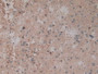 DAB staining on IHC-P; Samples: Human Glioma Tissue