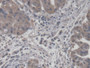 DAB staining on IHC-P; Samples: Human Liver cancer Tissue; Primary Ab: 20µg/ml Rabbit Anti-Human CORT Antibody Second Ab: 2µg/mL HRP-Linked Caprine Anti-Rabbit IgG Polyclonal Antibody