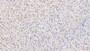DAB staining on IHC-P; Samples: Human Liver Tissue;  Primary Ab: 20µg/ml Rabbit Anti-Human CRAT Antibody Second Ab: 2µg/mL HRP-Linked Caprine Anti-Rabbit IgG Polyclonal Antibody 