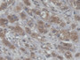 DAB staining on IHC-P; Samples: Human Breast cancer Tissue; Primary Ab: 20µg/ml Rabbit Anti-Human CRABP1 Antibody Second Ab: 2µg/mL HRP-Linked Caprine Anti-Rabbit IgG Polyclonal Antibody