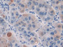 DAB staining on IHC-P; Samples: Human Liver cancer Tissue; Primary Ab: 20µg/ml Rabbit Anti-Human CILP Antibody Second Ab: 2µg/mL HRP-Linked Caprine Anti-Rabbit IgG Polyclonal Antibody