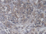 DAB staining on IHC-P; Samples: Human Breast cancer Tissue;  Primary Ab: 20µg/ml Rabbit Anti-Human C