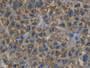 DAB staining on IHC-P; Samples: Human Liver cancer Tissue; Primary Ab: 20µg/ml Rabbit Anti-Human CDKN3 Antibody Second Ab: 2µg/mL HRP-Linked Caprine Anti-Rabbit IgG Polyclonal Antibody