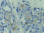DAB staining on IHC-P; Samples: Human Breast cancer Tissue; Primary Ab: 10µg/ml Rabbit Anti-Human CAPS Antibody Second Ab: 2µg/mL HRP-Linked Caprine Anti-Rabbit IgG Polyclonal Antibody