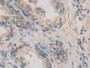 DAB staining on IHC-P; Samples: Human Prostate Tissue; Primary Ab: 10µg/ml Rabbit Anti-Human CACYBP Antibody Second Ab: 2µg/mL HRP-Linked Caprine Anti-Rabbit IgG Polyclonal Antibody