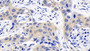 DAB staining on IHC-P; Samples: Human Lung cancer Tissue; Primary Ab: 20ug/ml Rabbit Anti-Human CASP6 Antibody Second Ab: 2µg/mL HRP-Linked Caprine Anti-Rabbit IgG Polyclonal Antibody