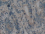 DAB staining on IHC-P; Samples: Human Stomach cancer Tissue; Primary Ab: 10µg/ml Rabbit Anti-Human BMF Antibody Second Ab: 2µg/mL HRP-Linked Caprine Anti-Rabbit IgG Polyclonal Antibody