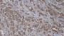 DAB staining on IHC-P; Samples: Human Breast cancer Tissue;  Primary Ab: 20µg/ml Rabbit Anti-Human BCOR Antibody Second Ab: 2µg/mL HRP-Linked Caprine Anti-Rabbit IgG Polyclonal Antibody 