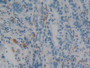 DAB staining on IHC-P; Samples: Human Stomach cancer Tissue; Primary Ab: 10µg/ml Rabbit Anti-Human AIF1 Antibody Second Ab: 2µg/mL HRP-Linked Caprine Anti-Rabbit IgG Polyclonal Antibody