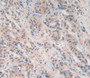 DAB staining on IHC-P; Samples：Human Breast Cancer Tissue.