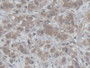 DAB staining on IHC-P; Samples: Human Breast cancer Tissue; Primary Ab: 20µg/ml Rabbit Anti-Human HCFC1 Antibody Second Ab: 2µg/mL HRP-Linked Caprine Anti-Rabbit IgG Polyclonal Antibody