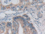 DAB staining on IHC-P; Samples: Human Colorectal cancer Tissue; Primary Ab: 30µg/ml Rabbit Anti-Human DSP Antibody Second Ab: 2µg/mL HRP-Linked Caprine Anti-Rabbit IgG Polyclonal Antibody