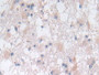 DAB staining on IHC-P; Samples: Human Glioma Tissue; Primary Ab: 30µg/ml Rabbit Anti-Human SNX13 Antibody Second Ab: 2µg/mL HRP-Linked Caprine Anti-Rabbit IgG Polyclonal Antibody