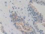DAB staining on IHC-P; Samples: Human Prostate Tissue;  Primary Ab: 10µg/ml Rabbit Anti-Human GRK6 A