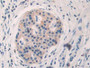 DAB staining on IHC-P; Samples: Human Pancreatic cancer Tissue; Primary Ab: 10µg/ml Rabbit Anti-Human ADRbK1 Antibody Second Ab: 2µg/mL HRP-Linked Caprine Anti-Rabbit IgG Polyclonal Antibody