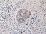 DAB staining on IHC-P; Samples: Human Pancreas Cancer Tissue.