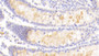 DAB staining on IHC-P; Samples: Human Colon Tissue;  Primary Ab: 20μg/ml Rabbit Anti-Human LEFTY1 Antibody Second Ab: 2µg/mL HRP-Linked Caprine Anti-Rabbit IgG Polyclonal Antibody 