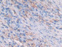 DAB staining on IHC-P; Samples: Human Lung cancer Tissue; Primary Ab: 20µg/ml Rabbit Anti-Human MHCDRb1 Antibody Second Ab: 2µg/mL HRP-Linked Caprine Anti-Rabbit IgG Polyclonal Antibody