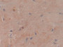 DAB staining on IHC-P; Samples: Human Esophagus Cancer Tissue.