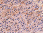 DAB staining on IHC-P; Samples: Human Liver cancer Tissue; Primary Ab: 10µg/ml Rabbit Anti-Human COL8a1 Antibody Second Ab: 2µg/mL HRP-Linked Caprine Anti-Rabbit IgG Polyclonal Antibody