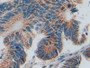 DAB staining on IHC-P; Samples: Human Rectum CancerTissue.