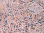 DAB staining on IHC-P; Samples: Human Prostate cancer Tissue; Primary Ab: 20µg/ml Rabbit Anti-Human IL24 Antibody Second Ab: 2µg/mL HRP-Linked Caprine Anti-Rabbit IgG Polyclonal Antibody