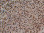 DAB staining on IHC-P; Samples: Human Colorectal cancer Tissue; Primary Ab: 20µg/ml Rabbit Anti-Human S100P Antibody Second Ab: 2µg/mL HRP-Linked Caprine Anti-Rabbit IgG Polyclonal Antibody