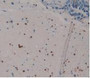 DAB staining on IHC-P; Samples: Human Breast Cancer Tissue.